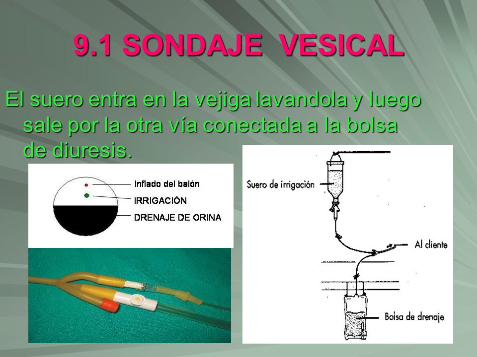 9.1 SONDAJE VESICAL El suero entra en la vejiga lavandola y luego sale por la otra vía conectada a la bolsa de diuresis.