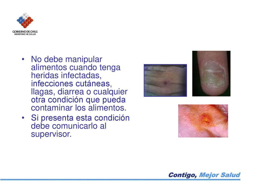 No debe manipular alimentos cuando tenga heridas infectadas, infecciones cutáneas, llagas, diarrea o cualquier otra condición que pueda contaminar los alimentos.
