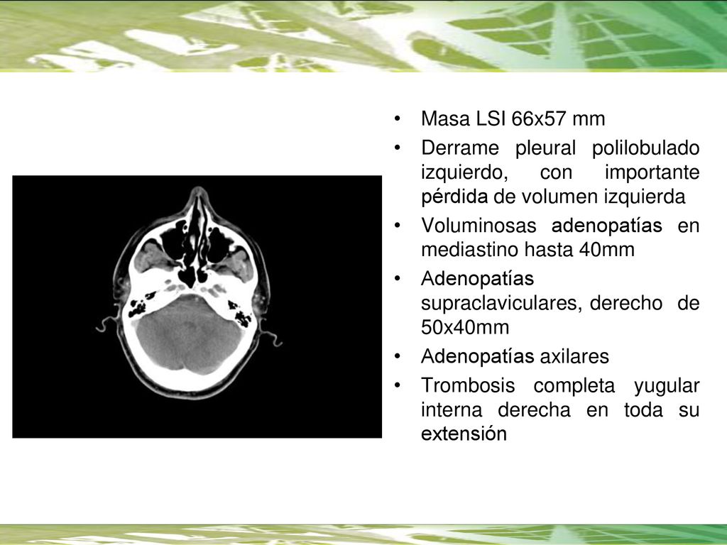 Masa LSI 66x57 mm Derrame pleural polilobulado izquierdo, con importante pérdida de volumen izquierda.