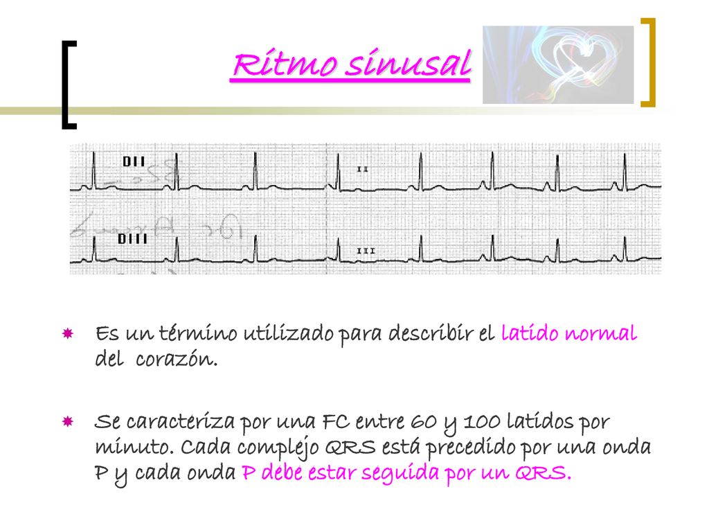 Ritmo sinusal Es un término utilizado para describir el latido normal del corazón.