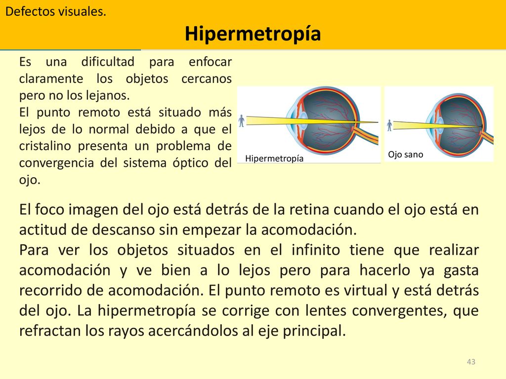 Defectos visuales. Hipermetropía. Es una dificultad para enfocar claramente los objetos cercanos pero no los lejanos.