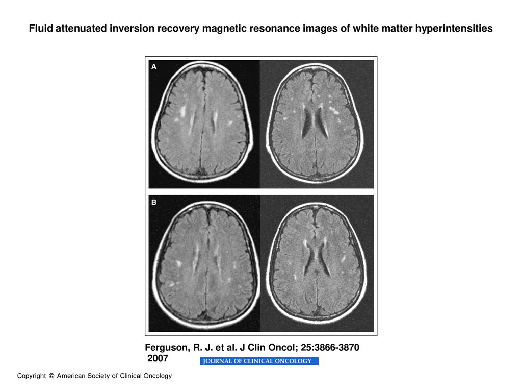 Fluid attenuated inversion recovery magnetic resonance images of white matter hyperintensities