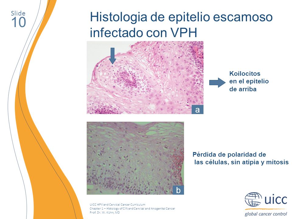 10 Histologia de epitelio escamoso infectado con VPH a b Slide