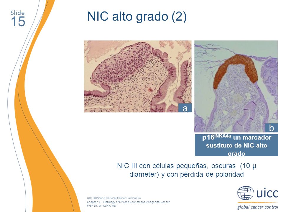 p16INKA4a un marcador sustituto de NIC alto grado