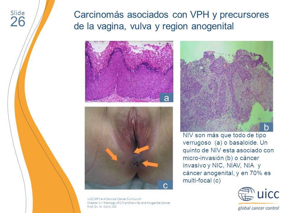 Slide Carcinomás asociados con VPH y precursores de la vagina, vulva y region anogenital. 26. a. b.