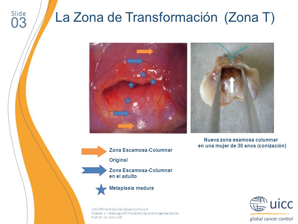 Nueva zona esamosa columnar en una mujer de 30 anos (conización)
