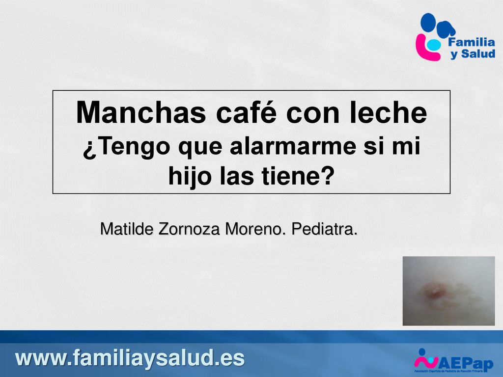 Manchas café con leche ¿Tengo que alarmarme si mi hijo las tiene