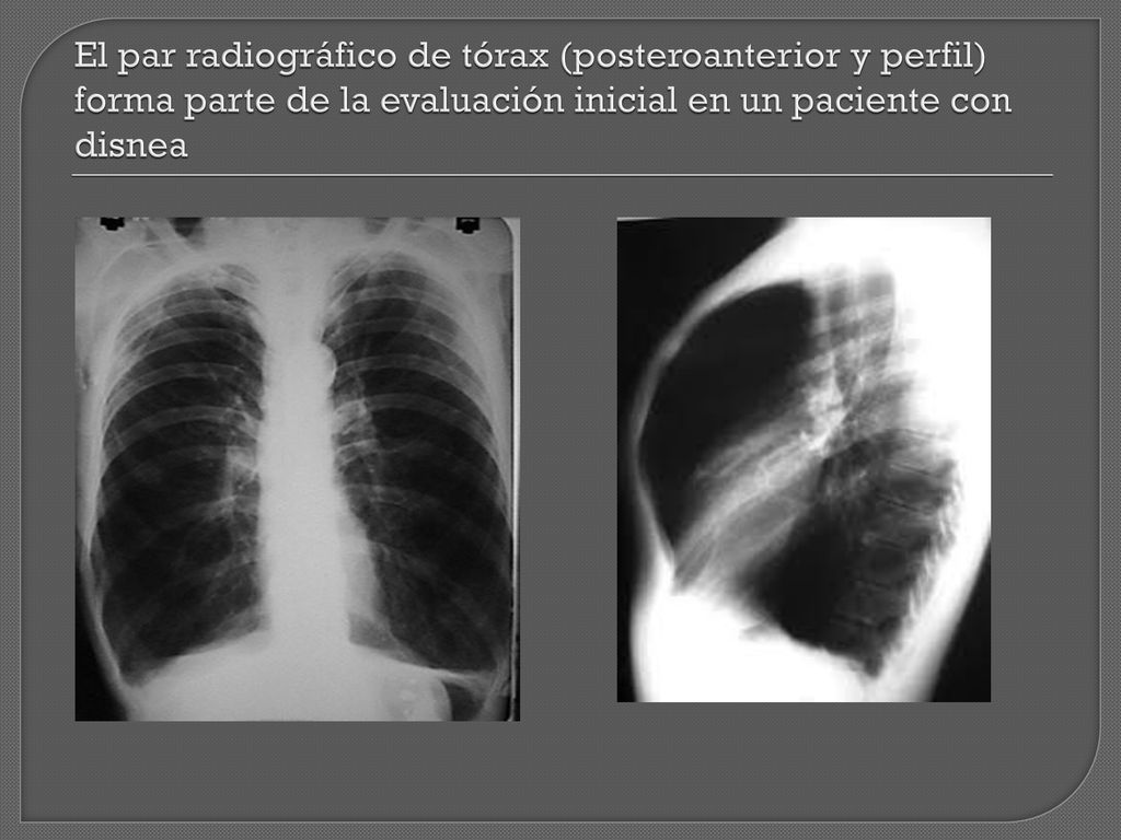 El par radiográfico de tórax (posteroanterior y perfil) forma parte de la evaluación inicial en un paciente con disnea