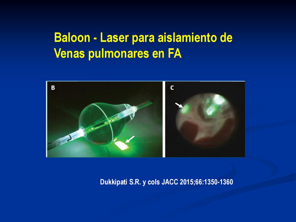 Baloon - Laser para aislamiento de Venas pulmonares en FA