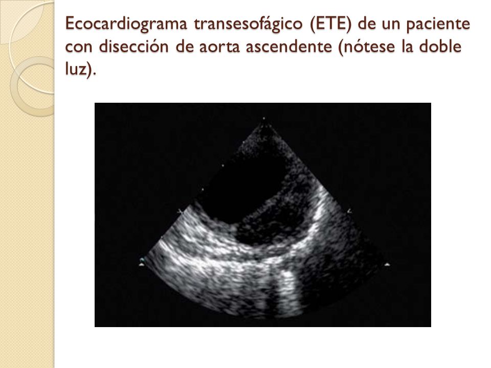 Ecocardiograma transesofágico (ETE) de un paciente con disección de aorta ascendente (nótese la doble luz).