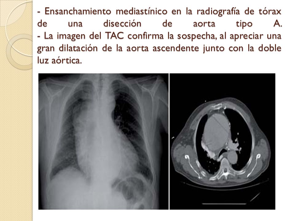 - Ensanchamiento mediastínico en la radiografía de tórax de una disección de aorta tipo A.