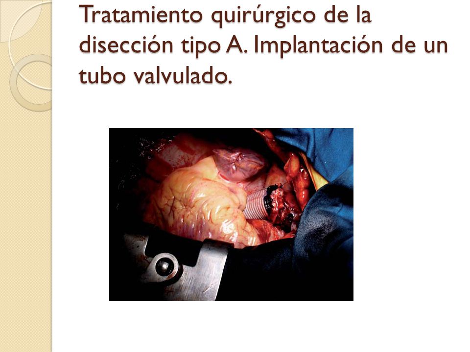 Tratamiento quirúrgico de la disección tipo A