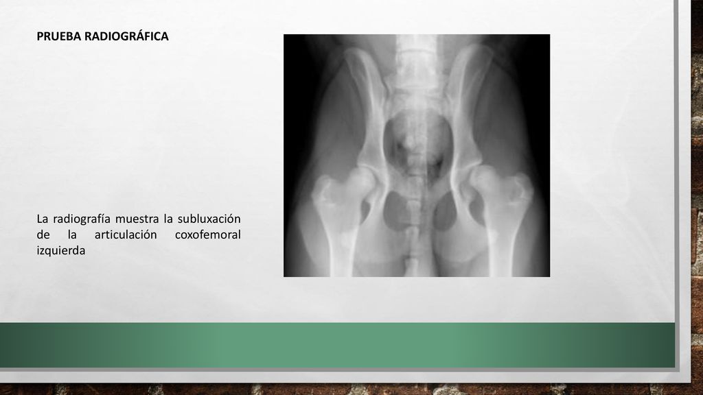 PRUEBA RADIOGRÁFICA La radiografía muestra la subluxación de la articulación coxofemoral izquierda