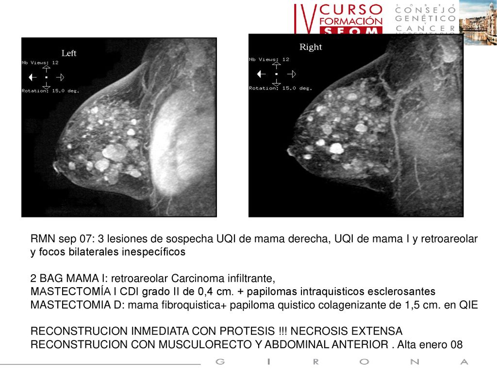 RMN sep 07: 3 lesiones de sospecha UQI de mama derecha, UQI de mama I y retroareolar y focos bilaterales inespecíficos