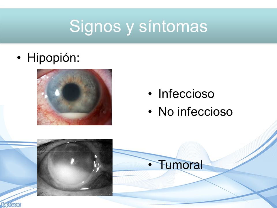 Signos y síntomas Signos y síntomas Hipopión: Infeccioso No infeccioso