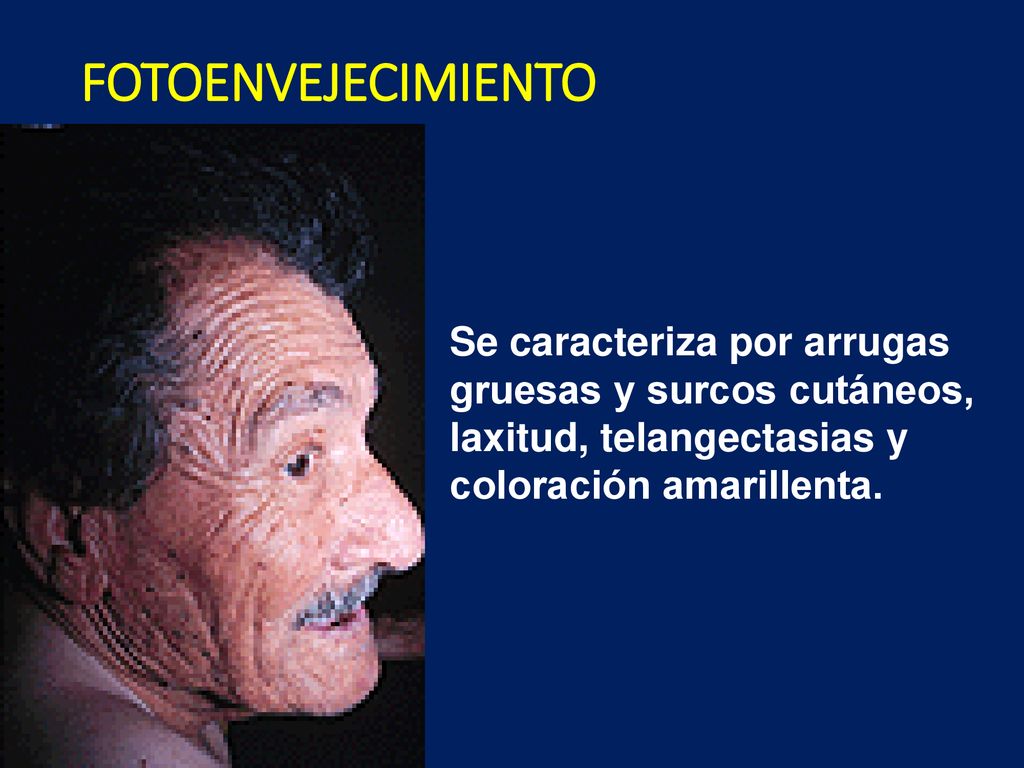FOTOENVEJECIMIENTO Se caracteriza por arrugas gruesas y surcos cutáneos, laxitud, telangectasias y coloración amarillenta.