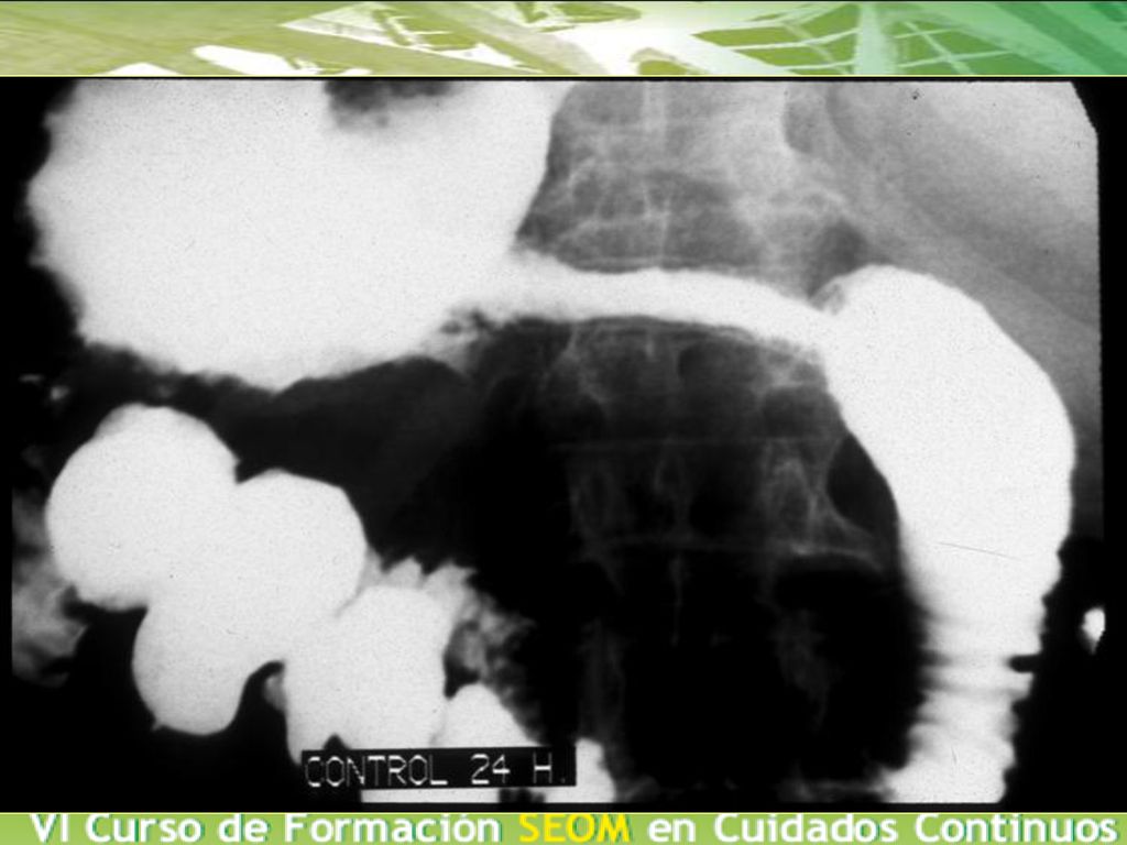 Aquí podemos ver la estenosis, con la posterior colocacion del stent y el control a las 24h con restablecimiento del transito