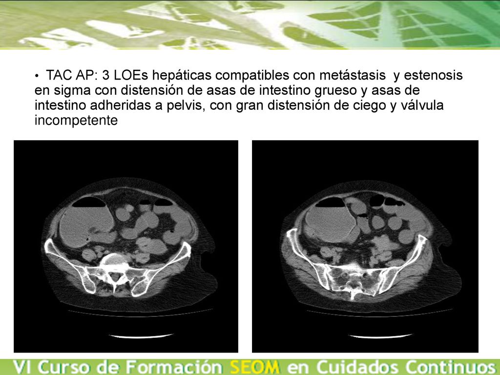 TAC AP: 3 LOEs hepáticas compatibles con metástasis y estenosis en sigma con distensión de asas de intestino grueso y asas de intestino adheridas a pelvis, con gran distensión de ciego y válvula incompetente