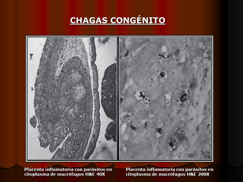 CHAGAS CONGÉNITO Placenta inflamatoria con parásitos en citoplasma de macrófagos H&E 40X.