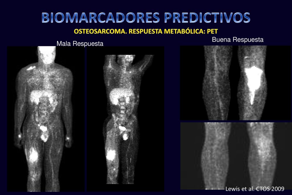 BIOMARCADORES PREDICTIVOS OSTEOSARCOMA. RESPUESTA METABÓLICA: PET