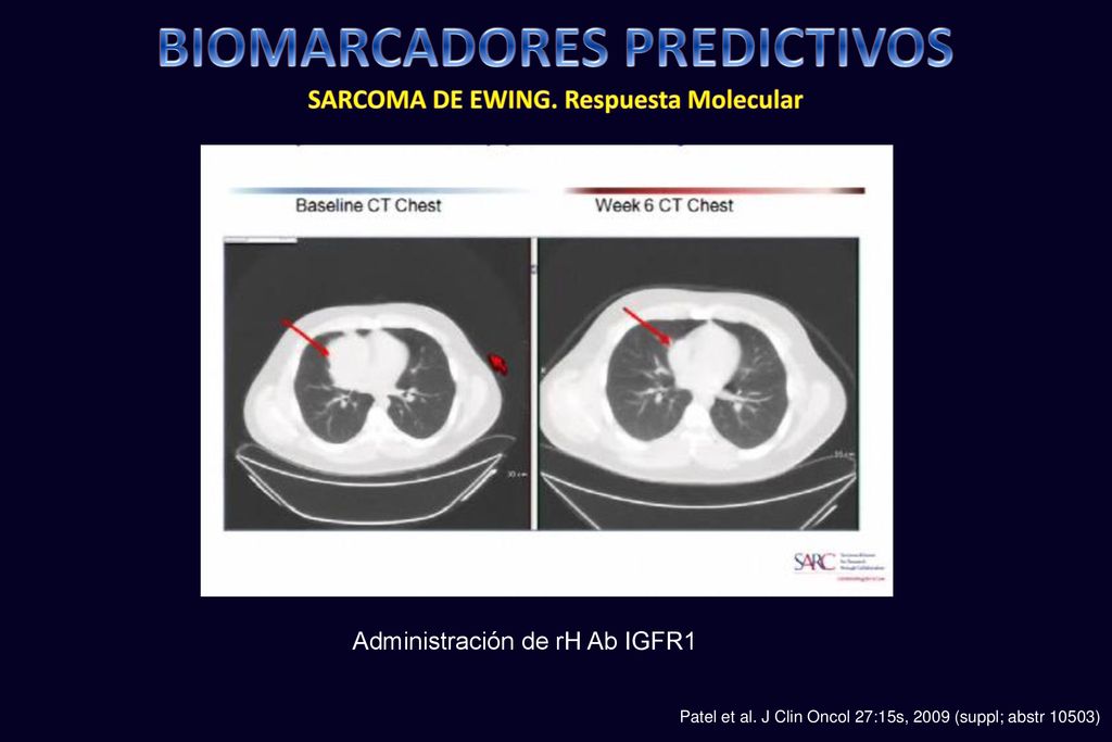 BIOMARCADORES PREDICTIVOS SARCOMA DE EWING. Respuesta Molecular