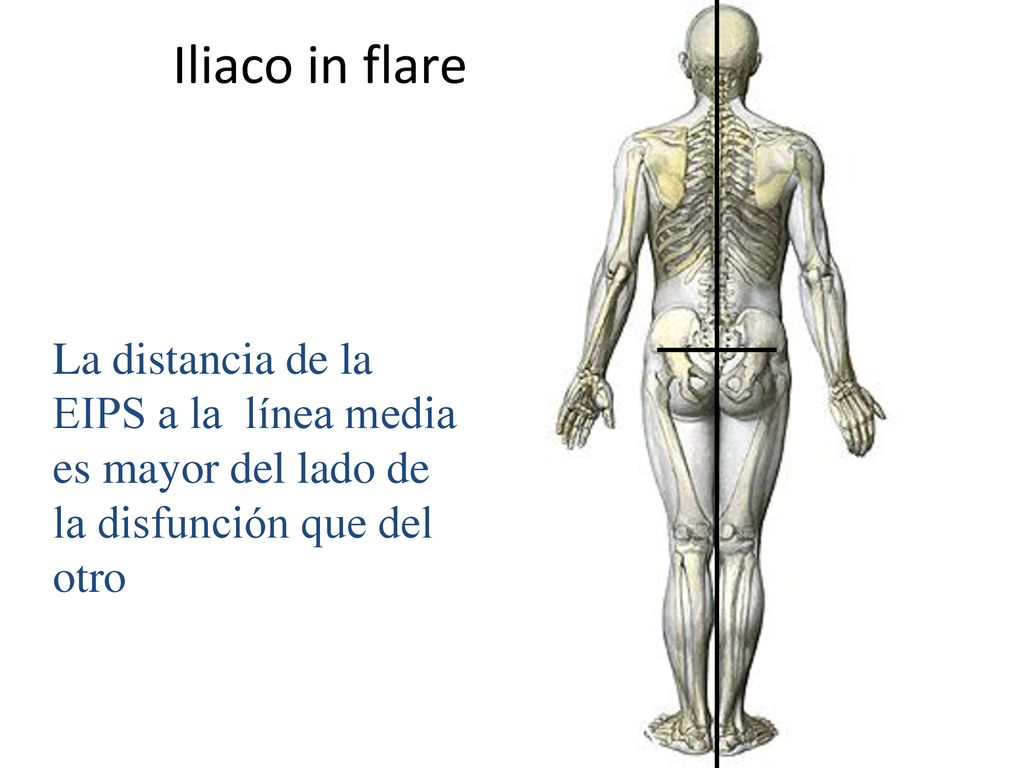 Iliaco in flare La distancia de la EIPS a la línea media es mayor del lado de la disfunción que del otro.