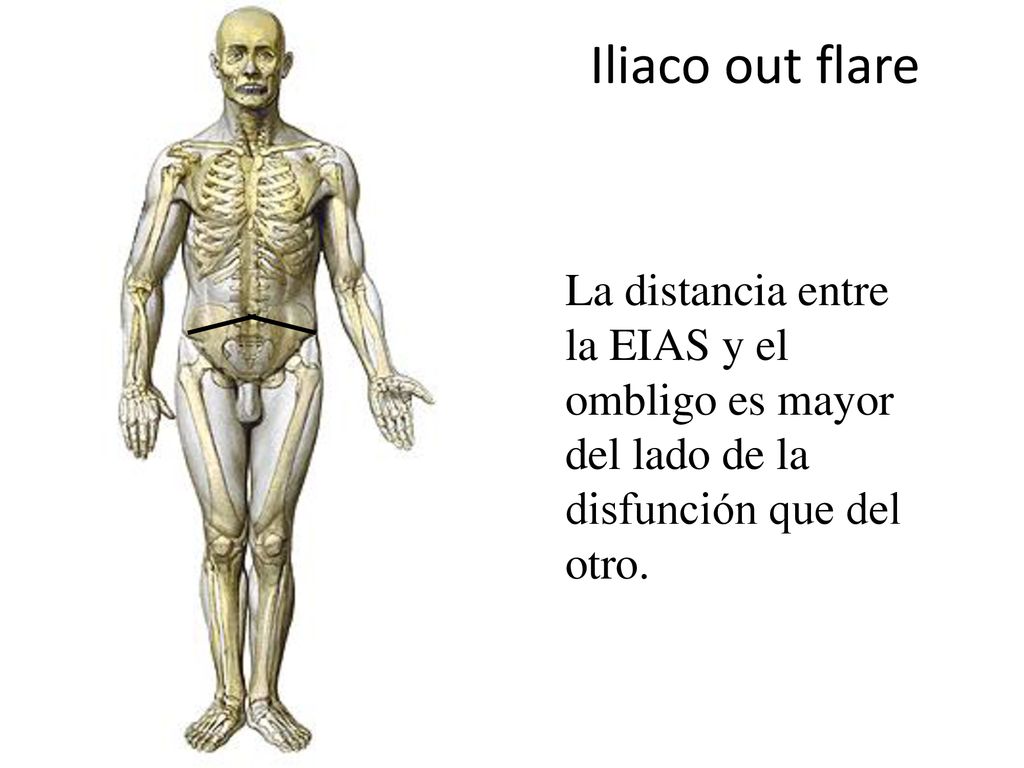 Iliaco out flare La distancia entre la EIAS y el ombligo es mayor del lado de la disfunción que del otro.