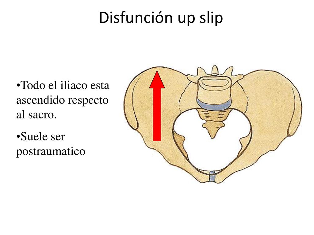 Disfunción up slip Todo el iliaco esta ascendido respecto al sacro.