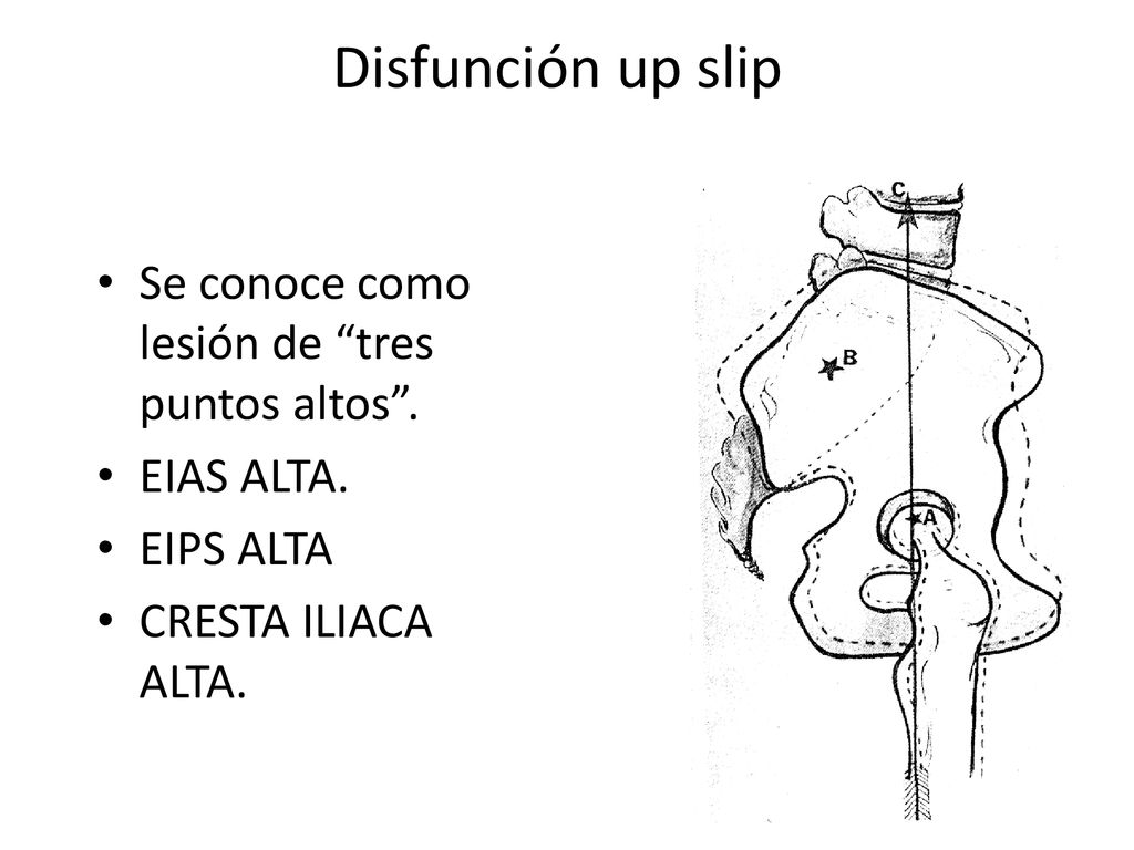 Disfunción up slip Se conoce como lesión de tres puntos altos .