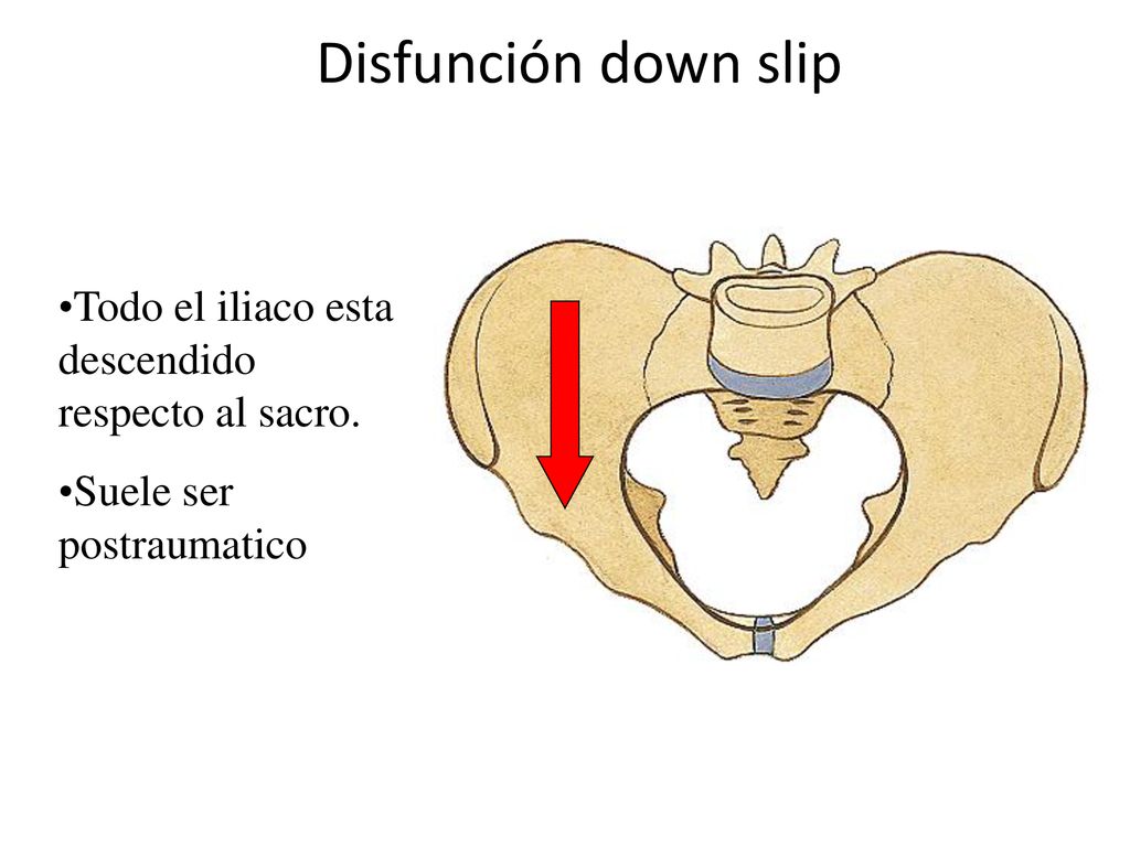 Disfunción down slip Todo el iliaco esta descendido respecto al sacro.