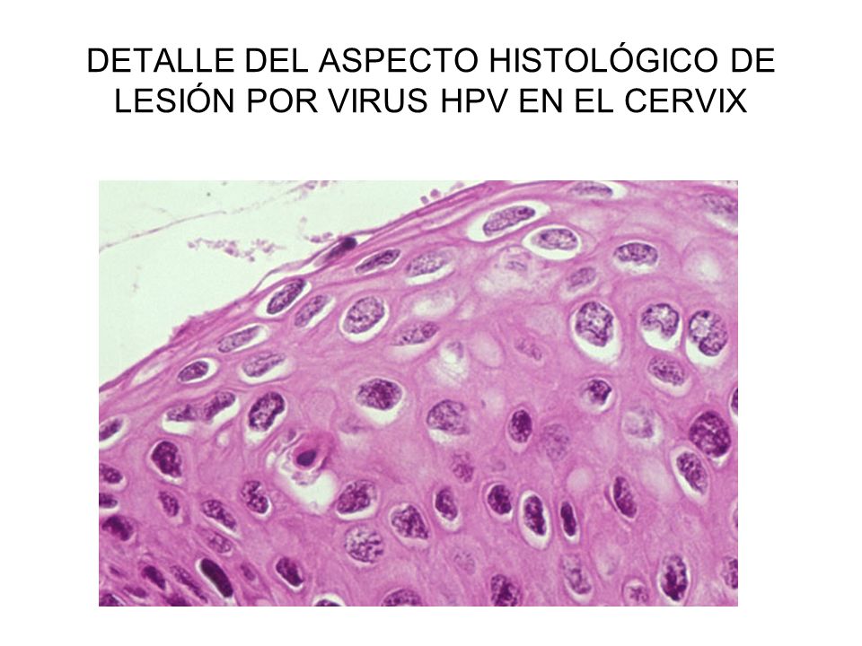 DETALLE DEL ASPECTO HISTOLÓGICO DE LESIÓN POR VIRUS HPV EN EL CERVIX