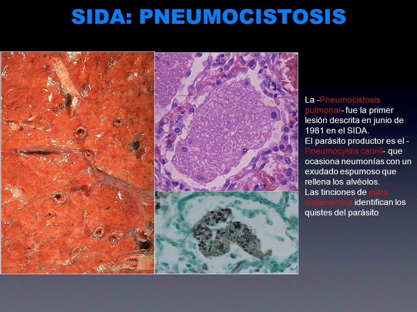 SIDA: PNEUMOCISTOSIS La -Pneumocistosis pulmonar- fue la primer lesión descrita en junio de 1981 en el SIDA.