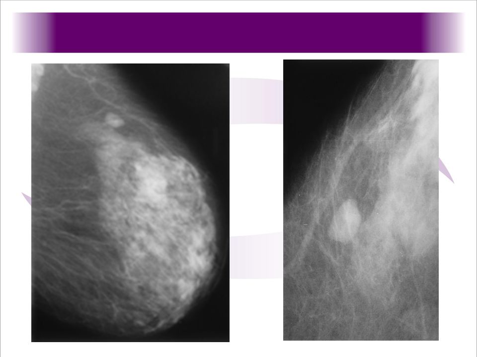 1.-(1a) Mediolateral oblique mammogram of the left breast shows a lobulated, circumscribed mass