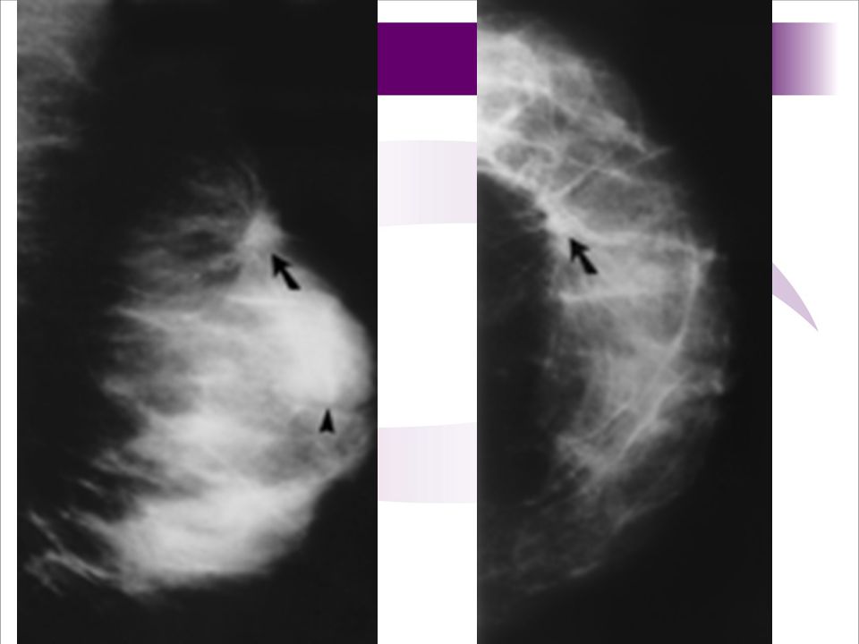 Figure 1. (a) Mediolateral oblique mammogram of the left breast shows a circumscribed mass (arrowhead) and an unsuspected spiculated lesion superior to it (arrow).