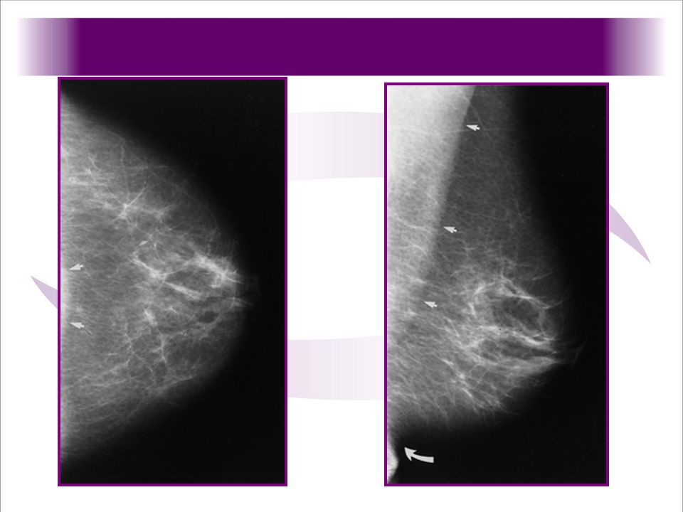 Proyeccion craneocaudal de la mama las flechas señalan el musculo pectoral, lo que indica adecuada visualizaicion del tejido mamario