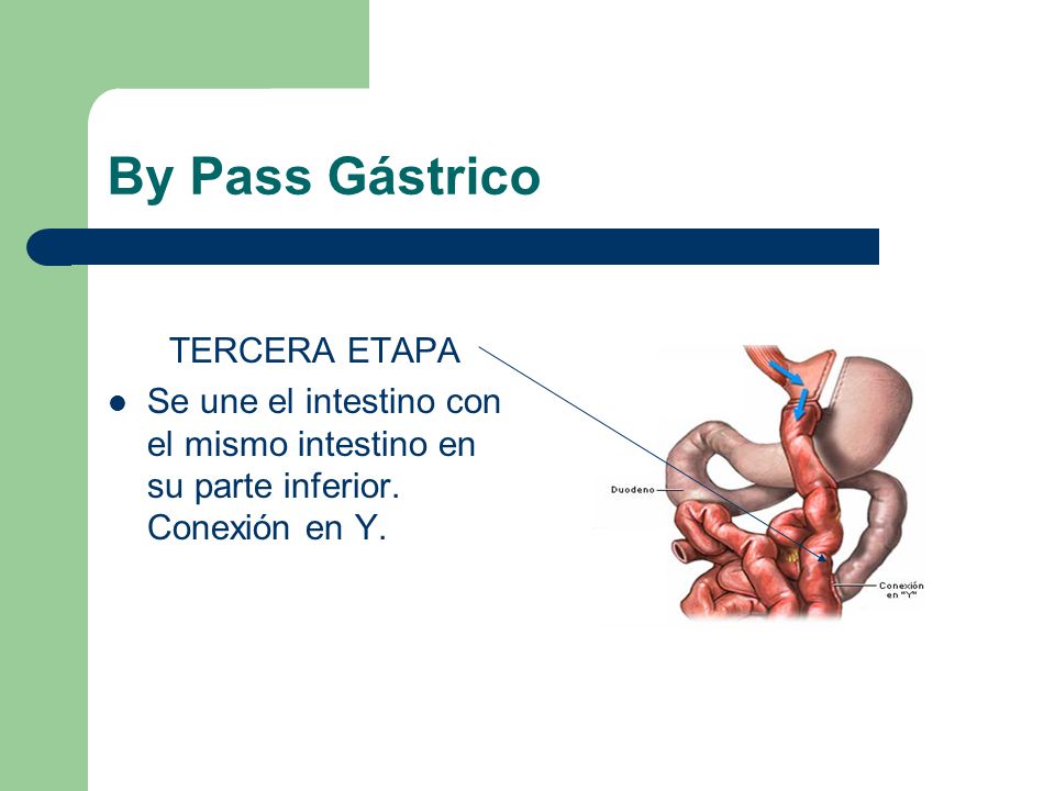 By Pass Gástrico TERCERA ETAPA
