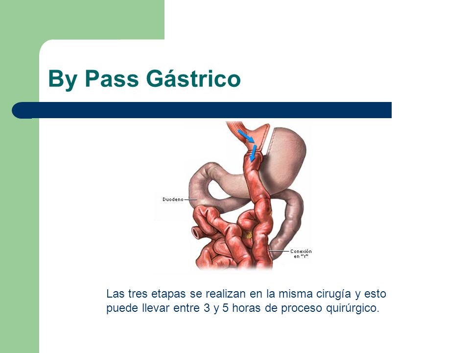 By Pass Gástrico Las tres etapas se realizan en la misma cirugía y esto puede llevar entre 3 y 5 horas de proceso quirúrgico.