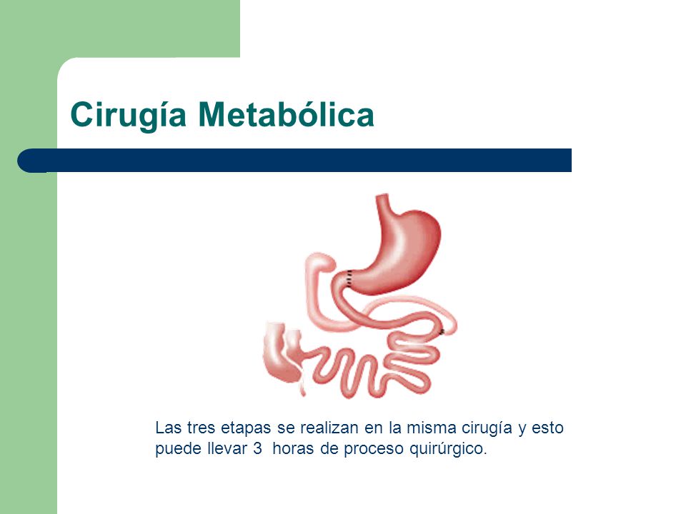Cirugía Metabólica Las tres etapas se realizan en la misma cirugía y esto puede llevar 3 horas de proceso quirúrgico.