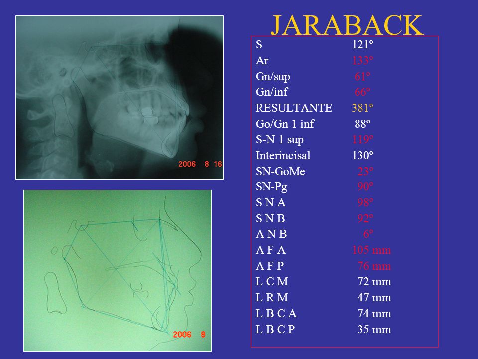 JARABACK S 121º Ar 133º Gn/sup 61º Gn/inf 66º RESULTANTE 381º