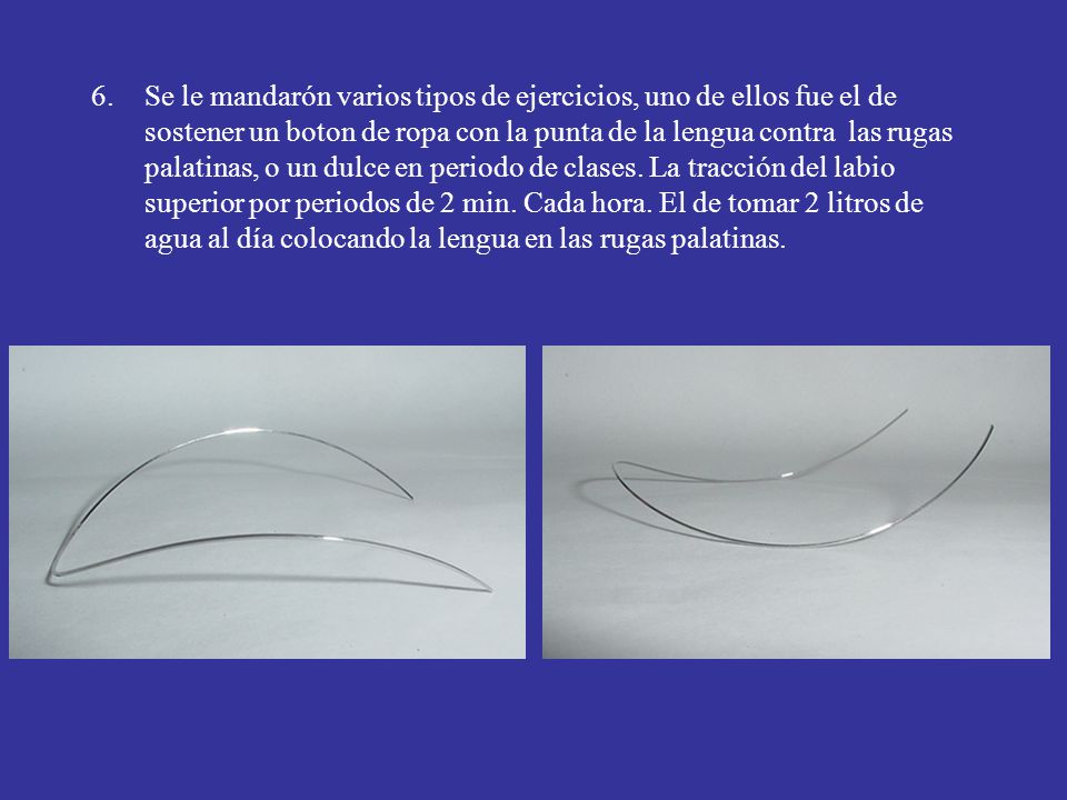 Se le mandarón varios tipos de ejercicios, uno de ellos fue el de sostener un boton de ropa con la punta de la lengua contra las rugas palatinas, o un dulce en periodo de clases.