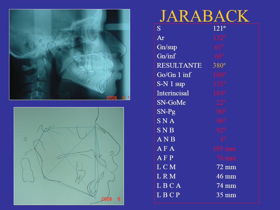 JARABACK S 121º Ar 132º Gn/sup 61º Gn/inf 66º RESULTANTE 380º