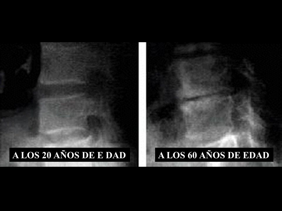 A LOS 20 AÑOS DE E DAD A LOS 60 AÑOS DE EDAD