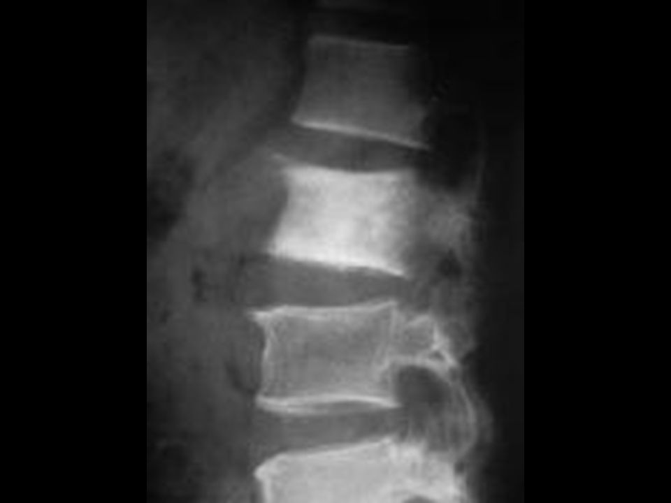 La radiografía lateral muestra metástasis de L2 de un hombre 54 años con carcinoma prostático