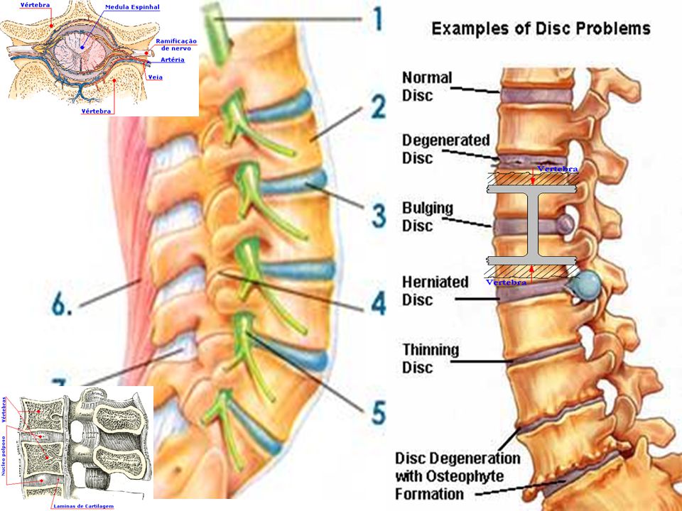 Desde el punto de vista biomecánico y fisiopatológico, la columna se sostiene entre sus diversas estructuras anatómicas, los cuerpos vertebrales, los discos, ligamentos y músculos de manera mas o menos homogénea, pero cuando por algun problema postura, asimetría, sobrecarga crónica, sobre peso, etc éste peso recae sobre alguna zona específica, esto puede desencadenar o acelerar un problema degenerativo del anillo fibroso, del cuerpo vertebral y el consiguiente cuadro doloroso
