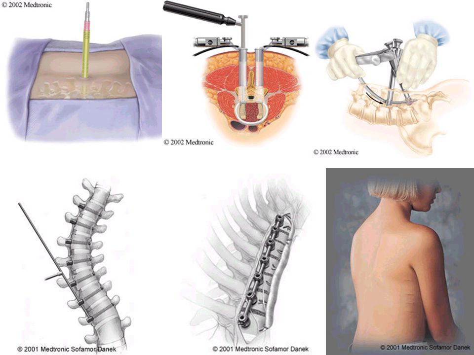 Discectomy La causa más común de bajo atrás el dolor es un disco del herniated.