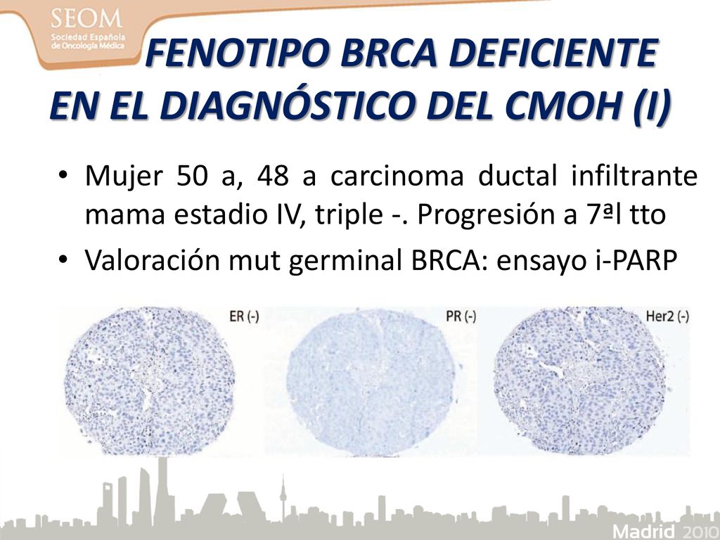FENOTIPO BRCA DEFICIENTE EN EL DIAGNÓSTICO DEL CMOH (I)