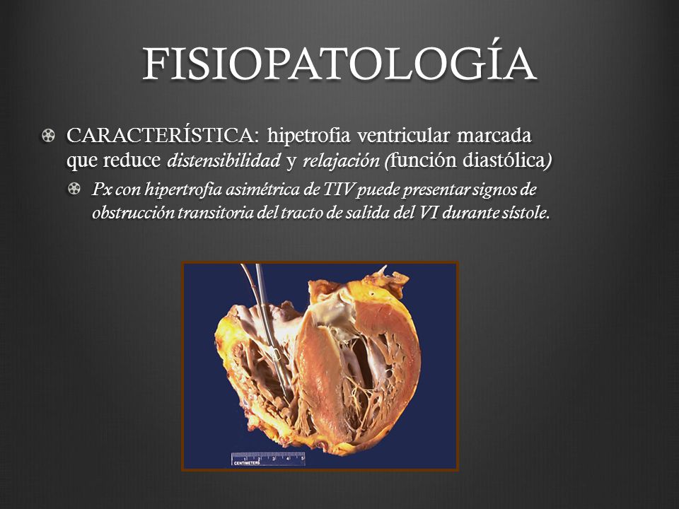 FISIOPATOLOGÍA CARACTERÍSTICA: hipetrofia ventricular marcada que reduce distensibilidad y relajación (función diastólica)