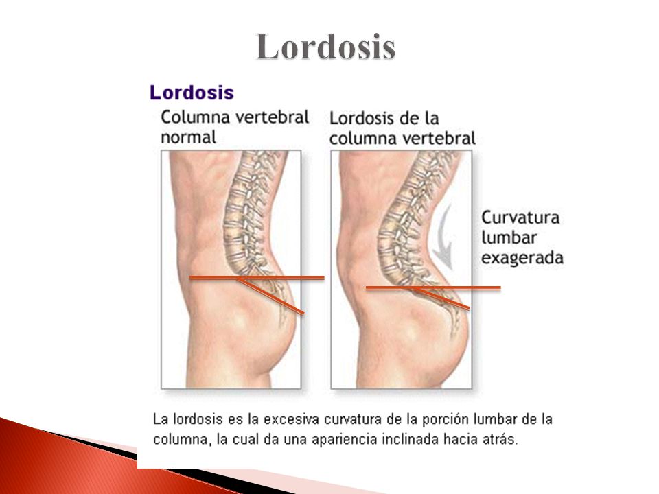 Lordosis Desde el punto de vista estructural, es más frecuente observar lordosis lumbares incrementadas en las mujeres. Aumenta el sacro.