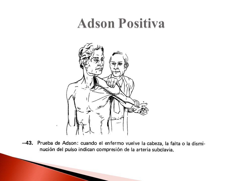 Adson Positiva Adson Para evaluar compresión del plexio braquial y la arteria subclavia. Causas de la compresión: