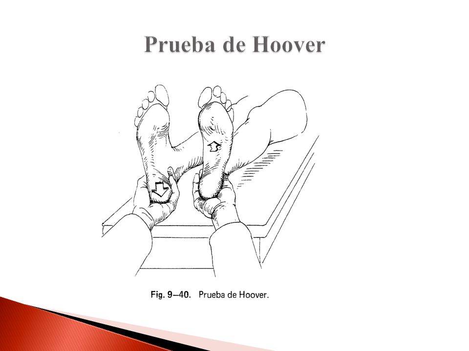 Prueba de Hoover El px al hacer el esfuerzo de levantar una pierna, se siente el esfuerzo de la otra.